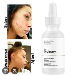 Salicylic acid/සැලිසිලික් ඇසිඩ්